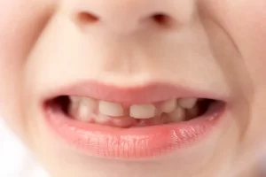 MFT（口腔筋機能療法）のトレーニング例